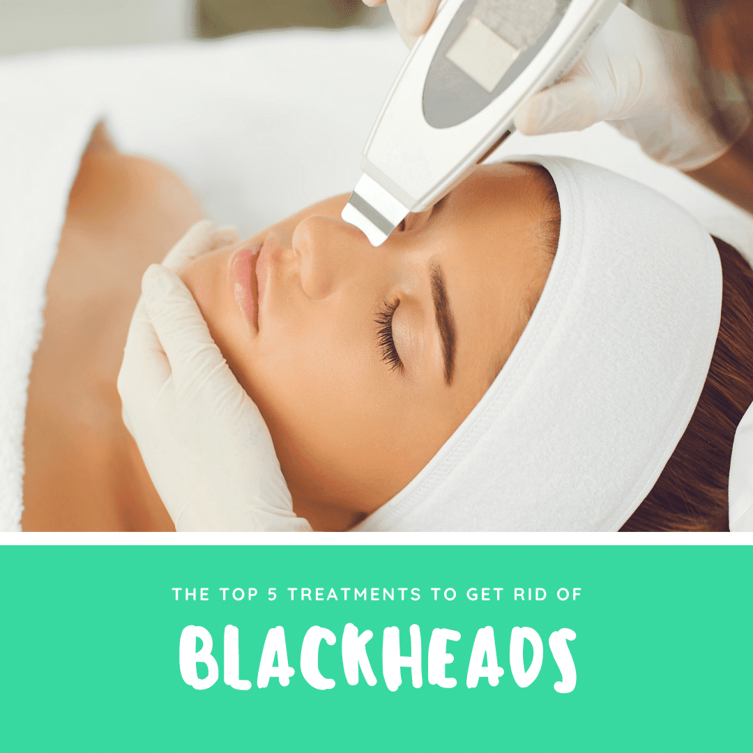 The Top 5 Treatments to Get Rid of blackheads